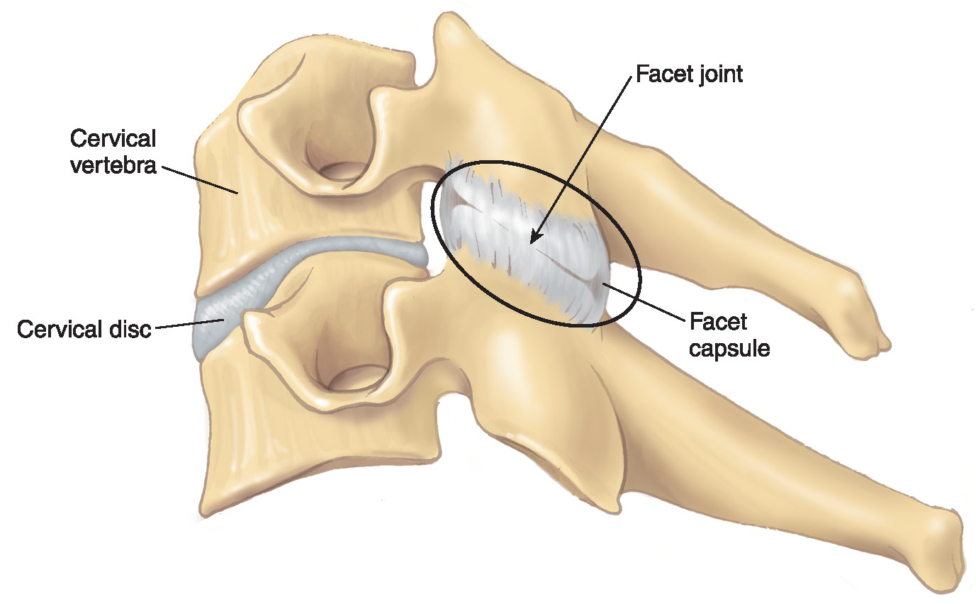 dolor-lumbar-cr-nico-y-s-ndrome-facetario-www-medspine-es